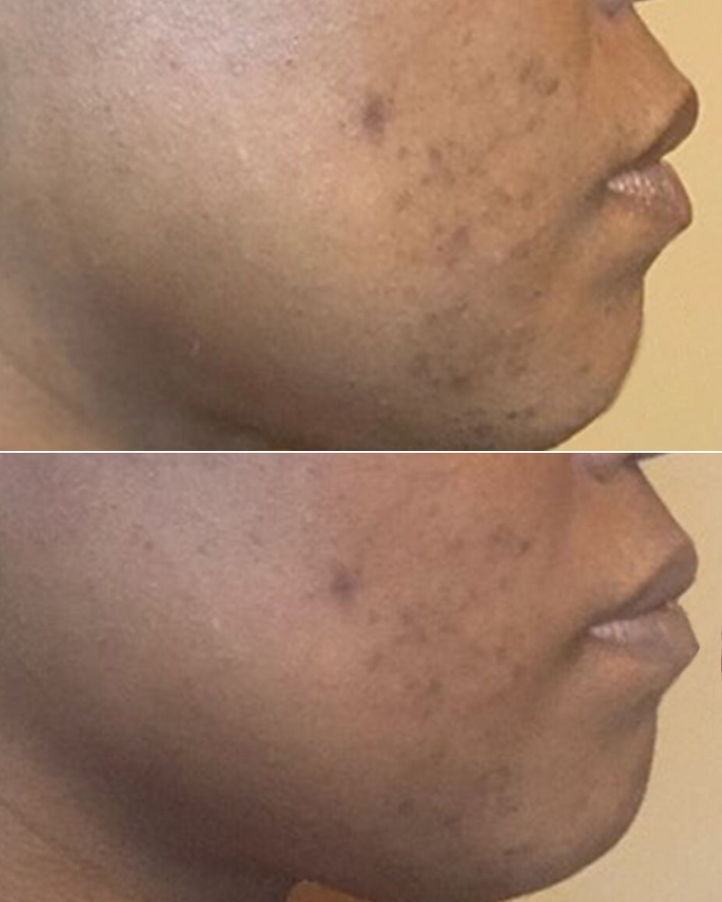 Correct & Protect Broad Spectrum SPF 45 Before and After