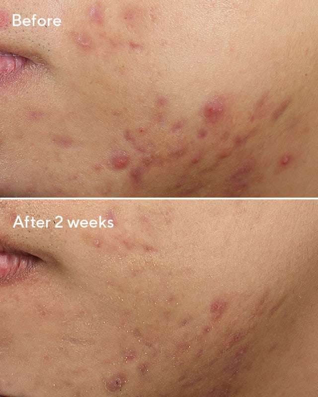 Murad Deep Relief Blemish Treatment, before and after, results