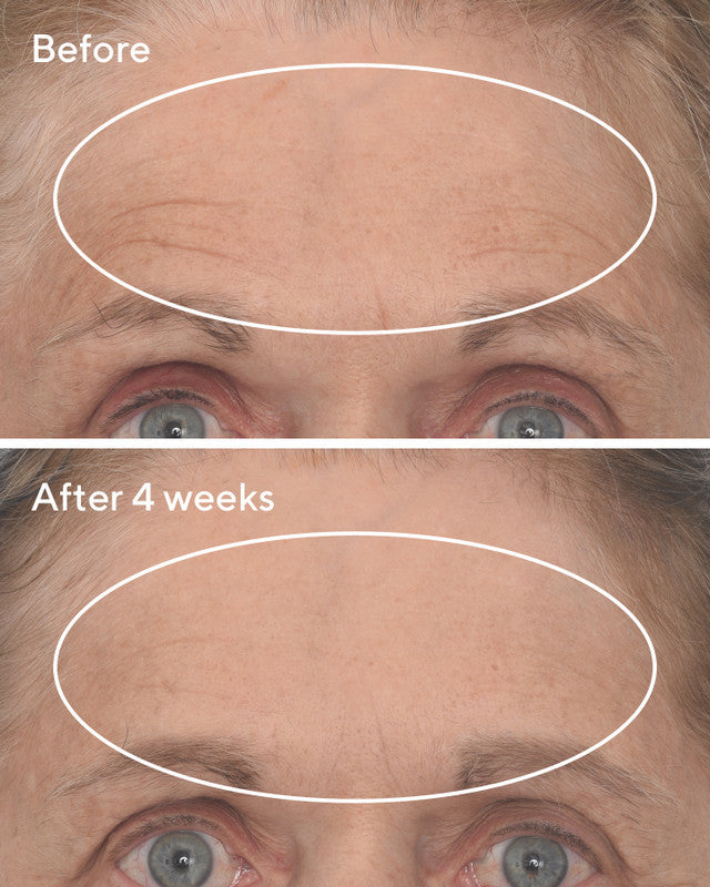 Before and after the use of Retinal ReSculpt™ Overnight Treatment